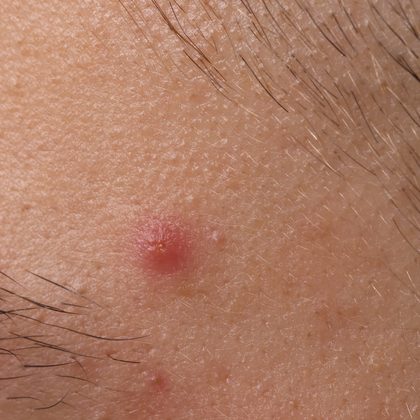 Pápula inflamatoria en mejilla