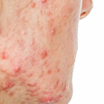 Pápulas y pústulas en zona mandibular