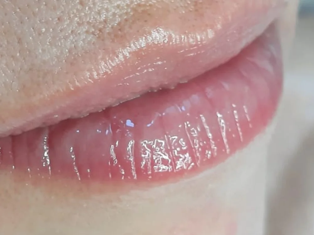 Hydralips con Dermapen — hidratación de labios