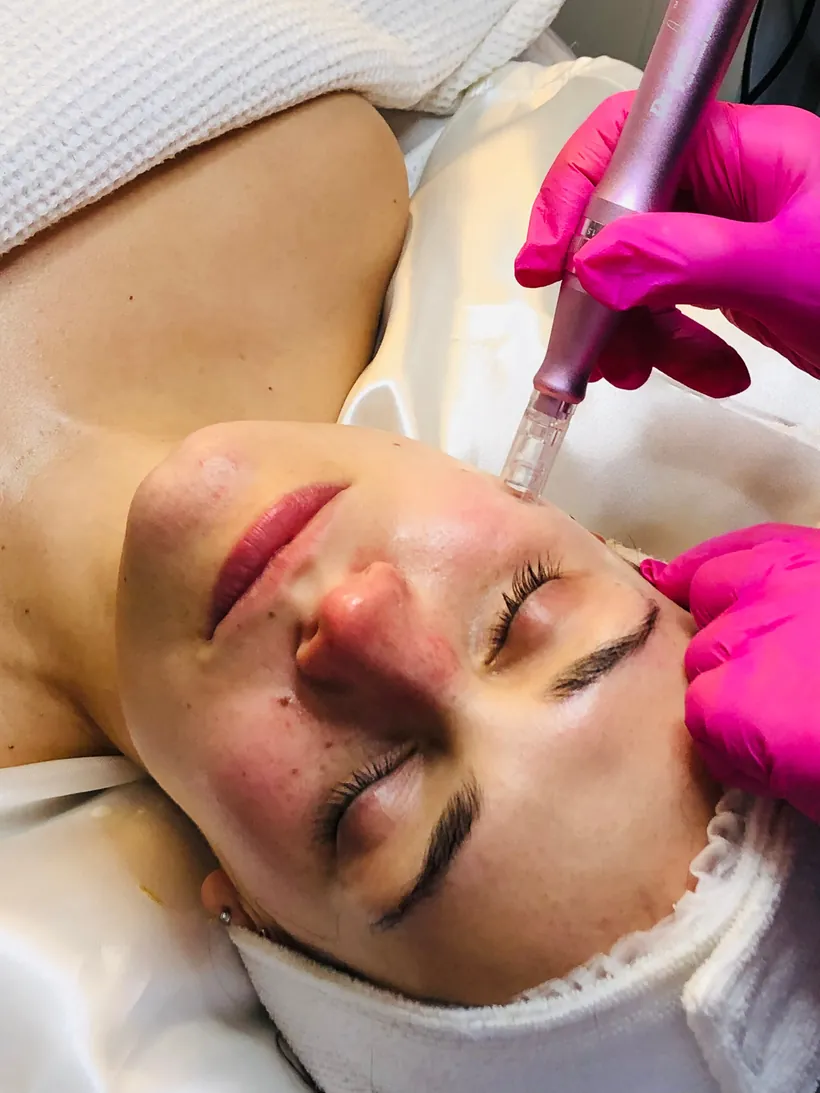 Microneedling con Nano Dermapen o Dermapen