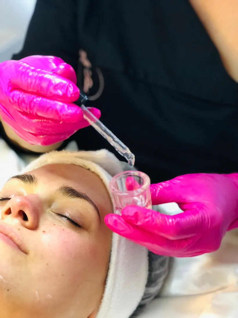 Peeling Químico
